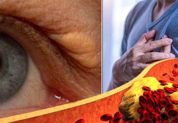 Tanda kolesterol tinggi