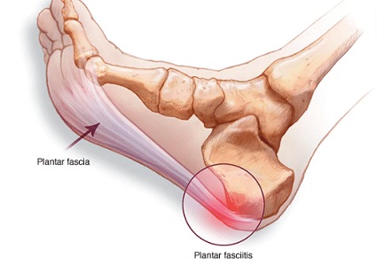 plantar fasciitis