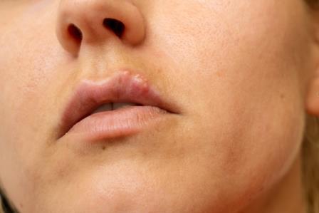 tanda dan gejala herpes mulut