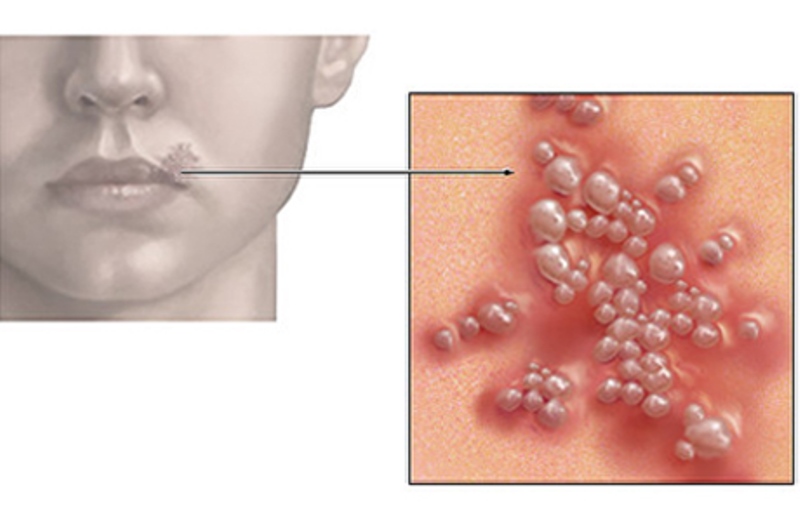 cara mengatasi penyakit herpes