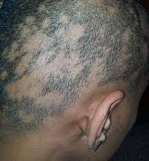 gejala penyebab rambut rontok pada sifilis