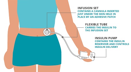 jenis-jenis insulin