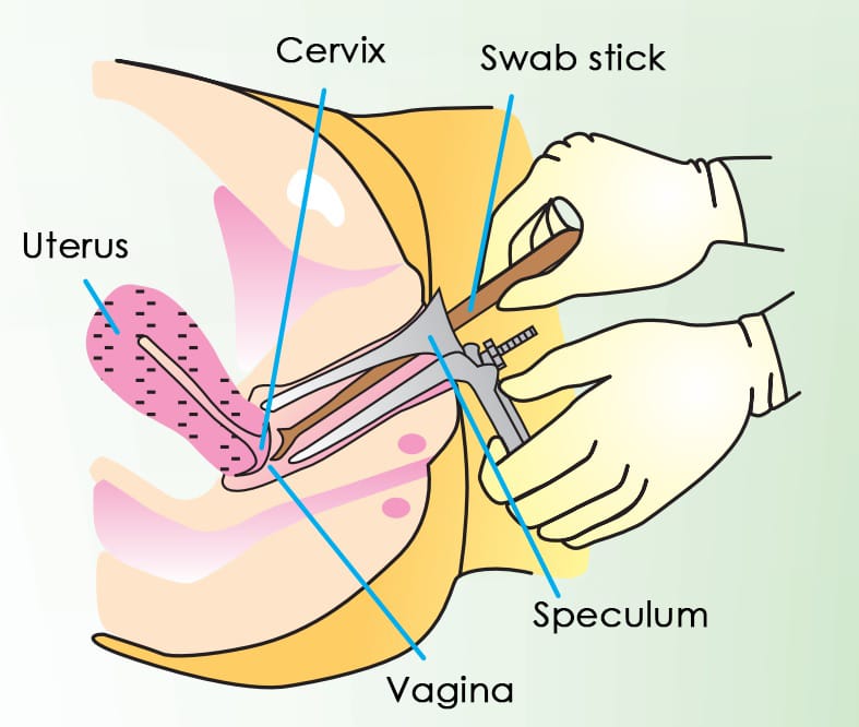 Pap smear untuk mengidentifikasi kanker serviks