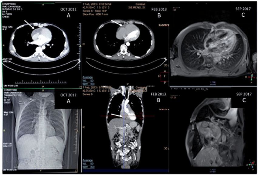 CT scan tumor jantung