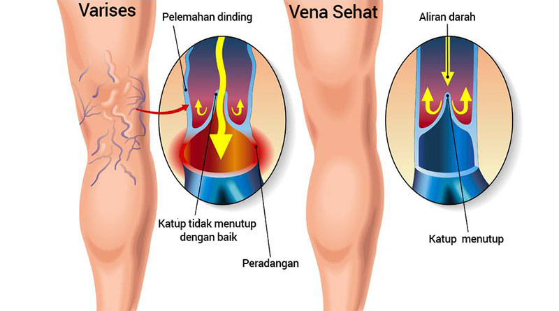 penyebab varises pada kaki