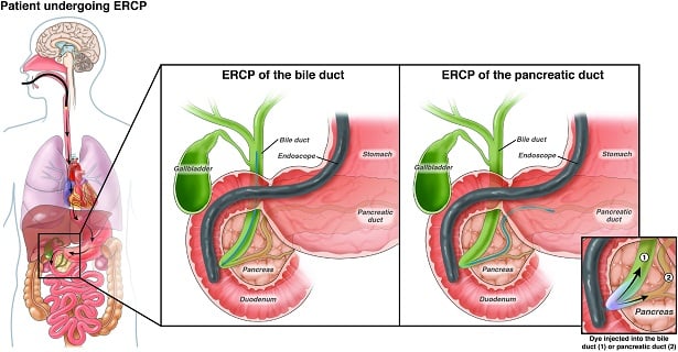 tindakan ERCP empedu kolesistitis kronis