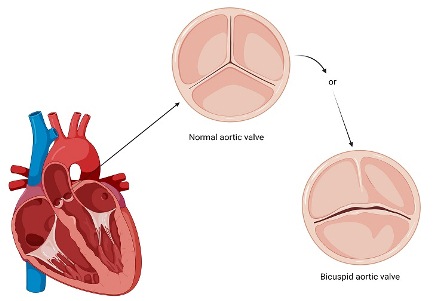 katup aorta bikuspid
