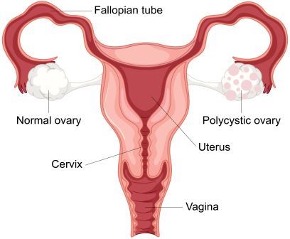 pcos akibat bahaya kegemukan untuk saluran reproduksi wanita
