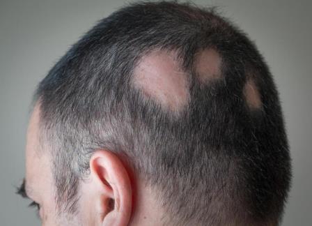 rambut pitak salah satu gejala dari penyebab rambut rontok