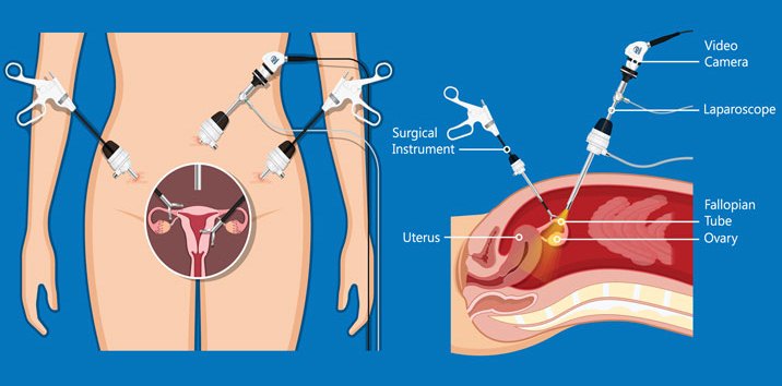 laparoskopi diagnosis