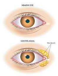 tanda kolesterol naik xanthelasma