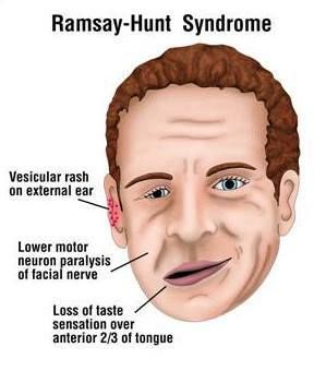ramsay hunt syndrome komplikasi cacar api
