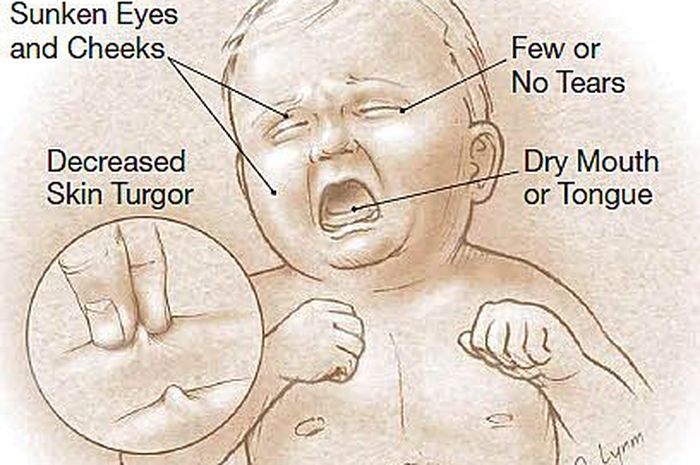 komplikasi flu singapur pada anak