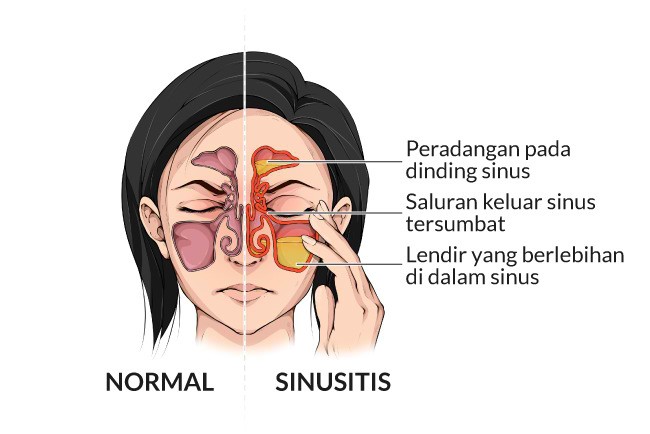 tanda mengalami sinusitis