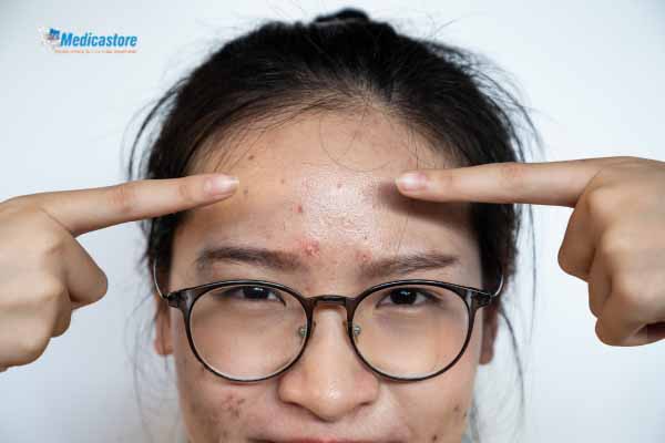 Penyebab Sering Muncul Jerawat Setelah Olahraga