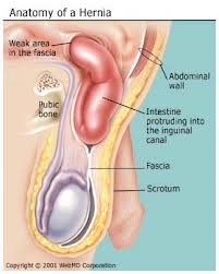 jenis-jenis hernia