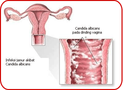 kandidiasis_vaginalis