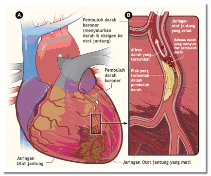 serangan jantung