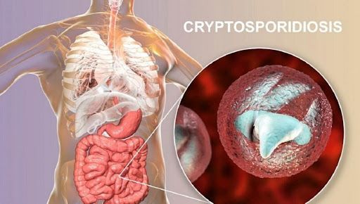Infeksi Usus Cryptosporidiosis