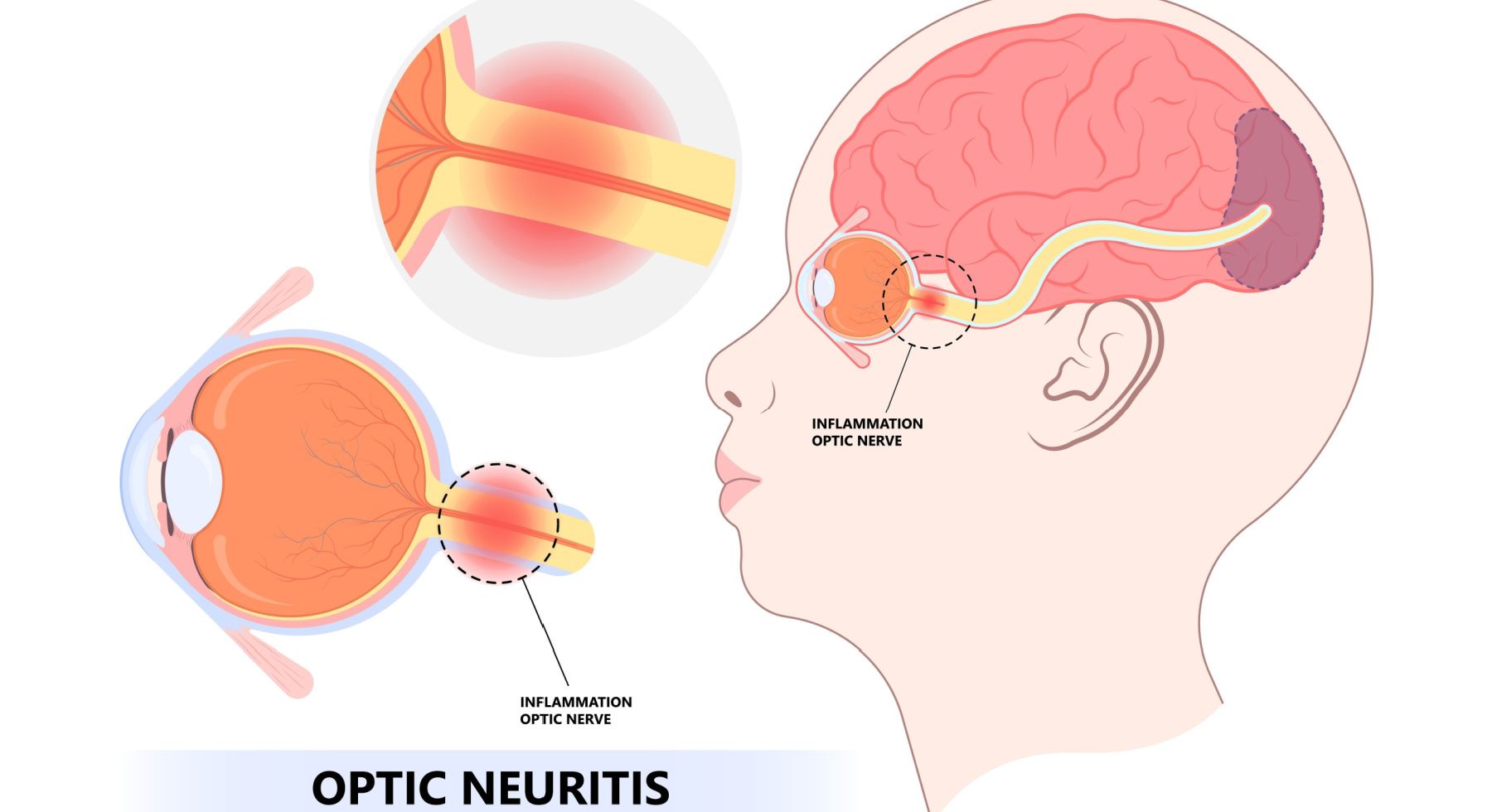 Neuritis optik
