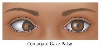 Conjugate Gaze Palsy