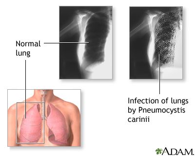 Pneumonia Pneumokistik