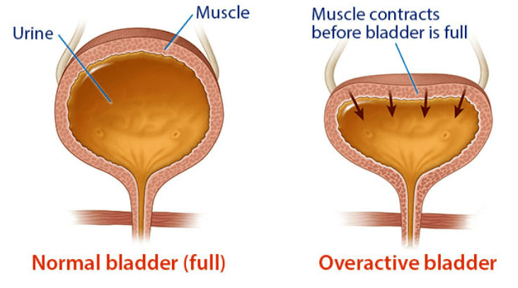 Overactive bladder (OAB)