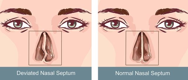 Deviasi Septum Hidung