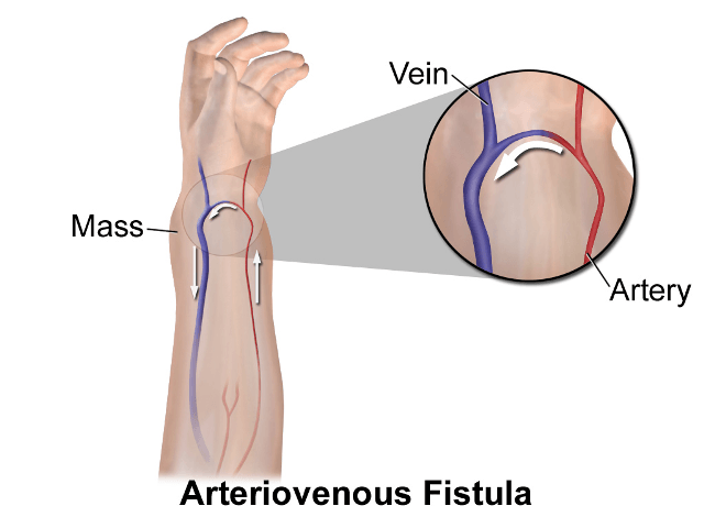 Fistula Arteriovenosa