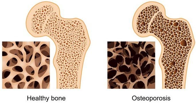 Osteoporosis (Tulang Keropos)