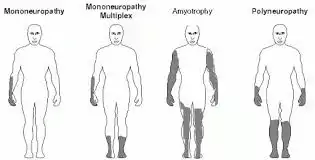 Multiple Mononeuropathy