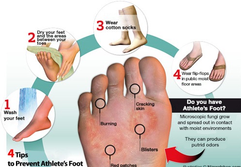 Tinea pedis (athlete's foot)