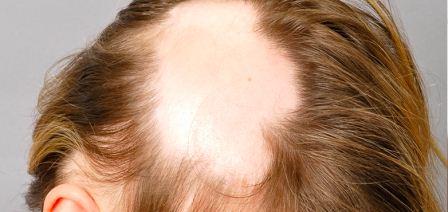 Kebotakan atau Alopecia