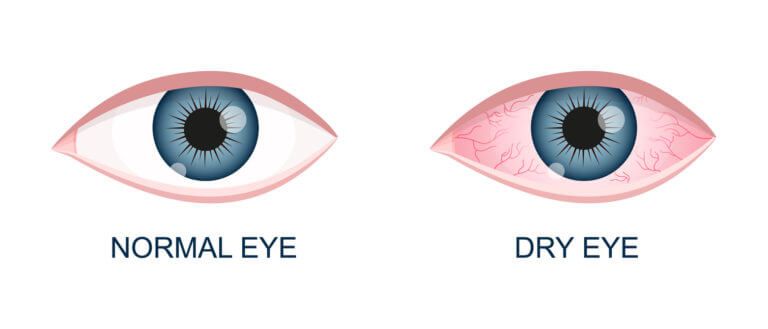 Dry Eye (Mata Kering)
