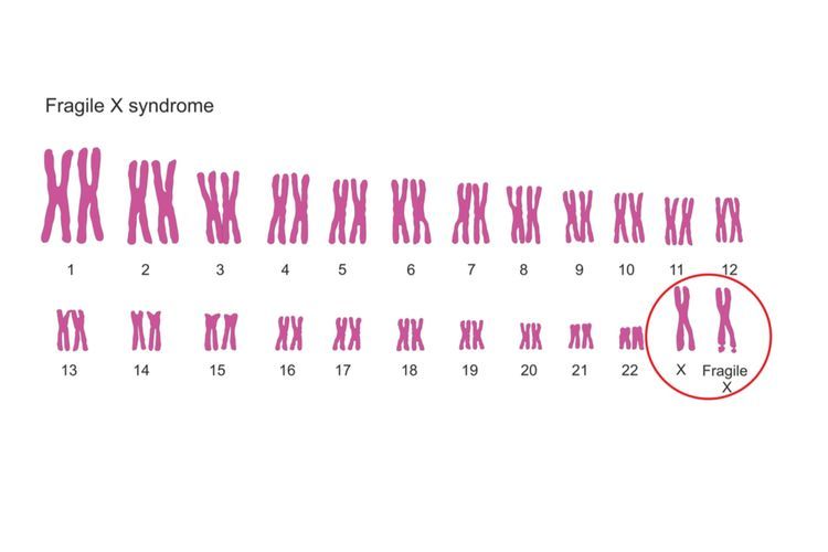 Sindroma Fragile X