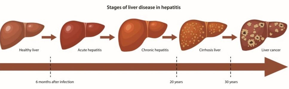 Hepatitis Kronis (Autoimun)