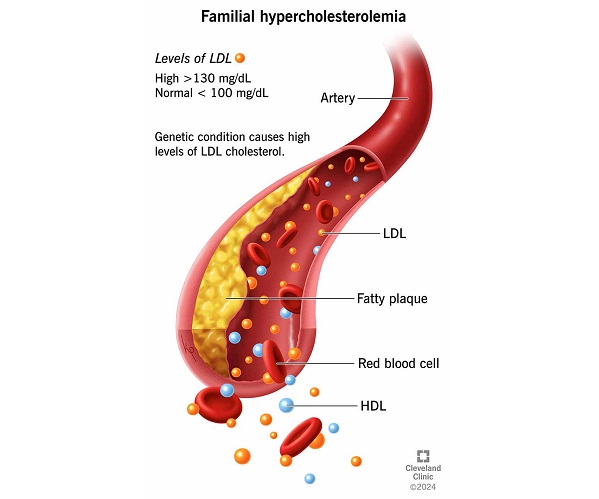 Hiperlipidemia Herediter