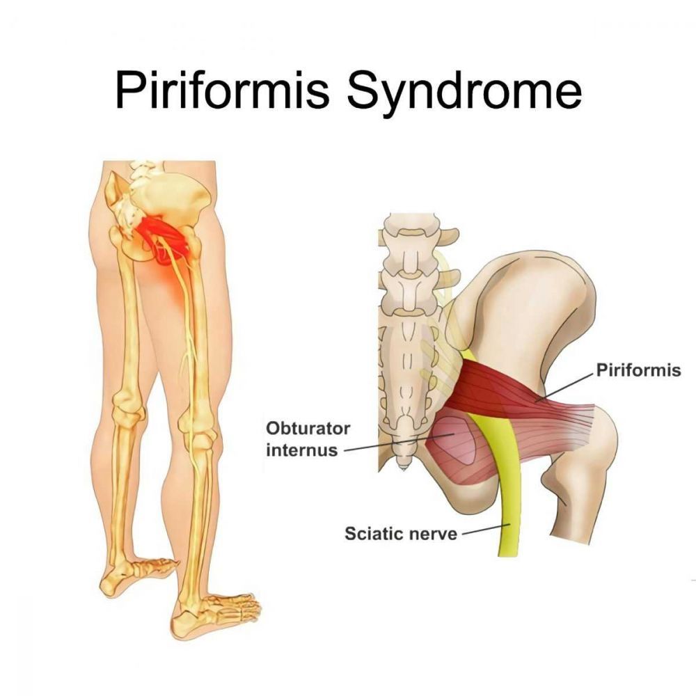 Sindroma Piriformis
