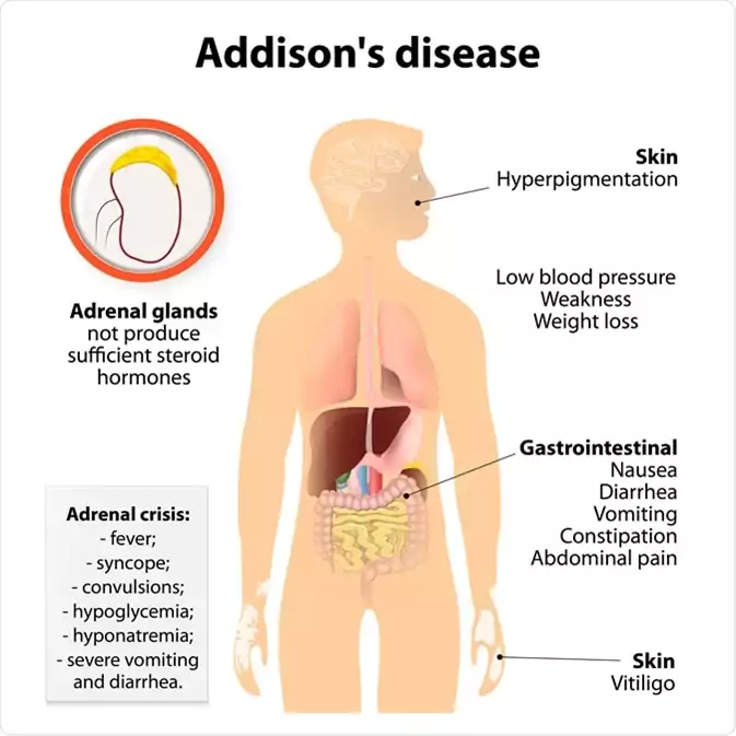 Penyakit Addison