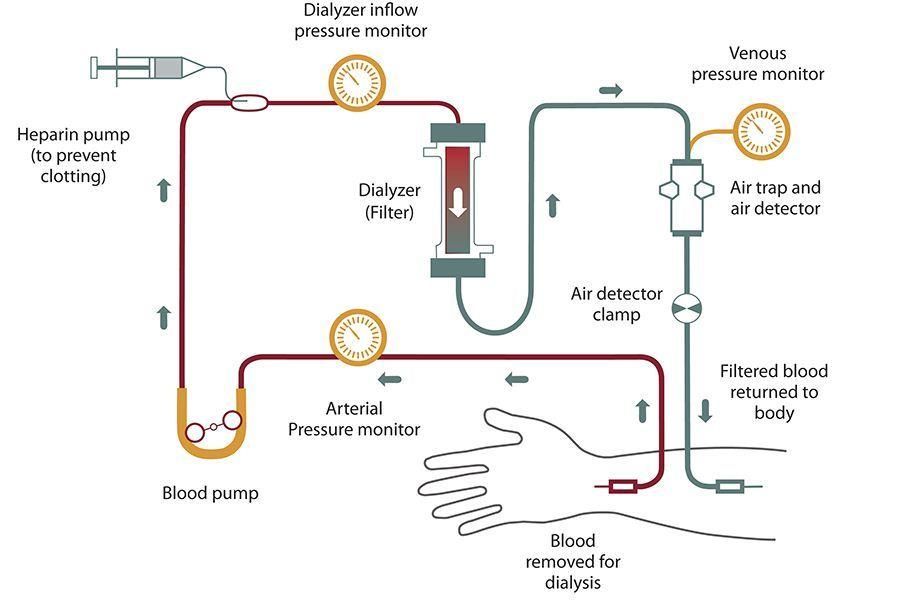 Dialisis; Hemodialisis dan Dialisis Peritoneal