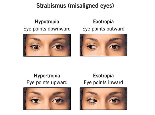 Mata Juling (Strabismus)