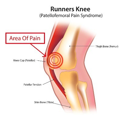 Patellofemoral Pain Syndrome; Runner's Knee, Nyeri Lutut pada Pelari