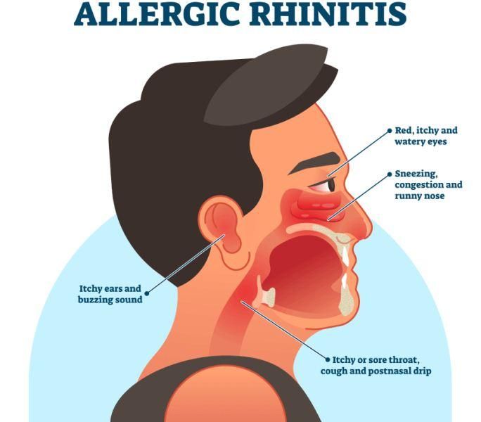 Rhinitis Alergi 