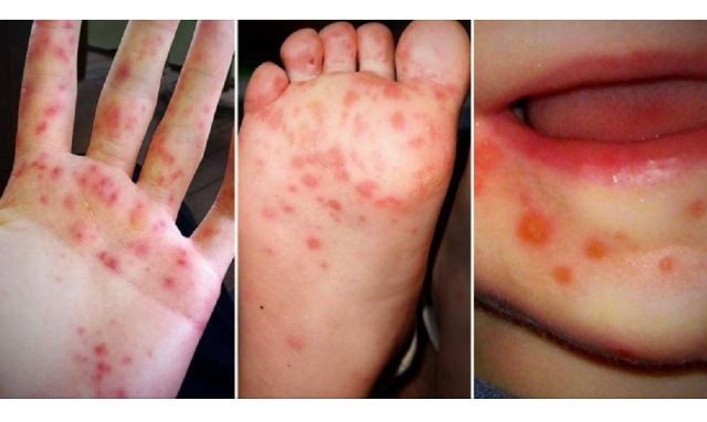 Flu Singapura; Hand Foot and Mouth Disease (HFMD)