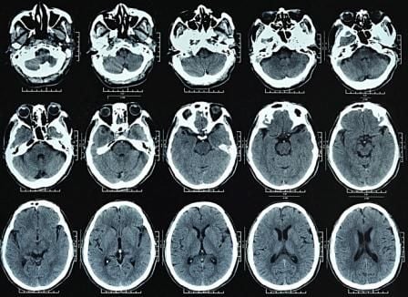 CT Scan Otak
