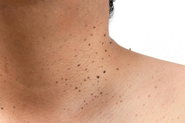 Skin Tags