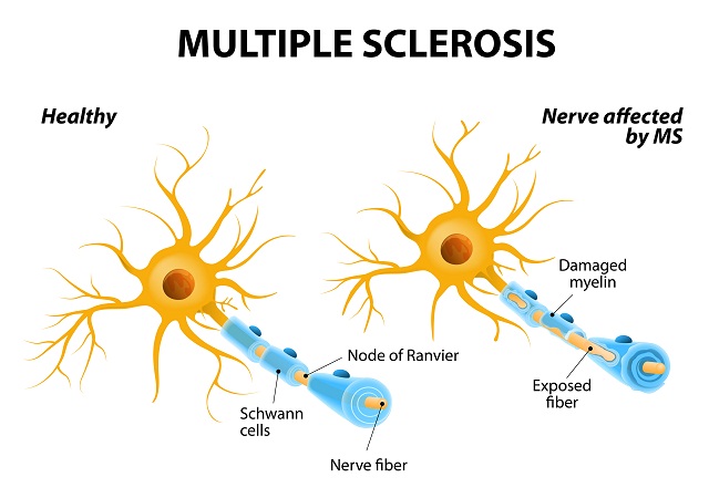 Sklerosis Multipel (Multiple Sclerosis)