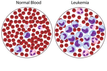 Leukemia Limfositik Akut