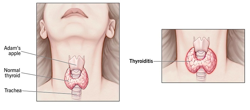 Tiroiditis (Radang Kelenjar Tiroid)