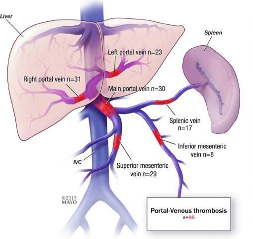 Trombosis Vena Porta